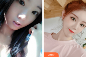 深圳吳小兵醫(yī)療美容診所吳小兵整形價格表附雙眼皮案例展示