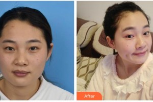 綿陽(yáng)口腔醫(yī)院整形美容科彭澤勛整形價(jià)格表附光子嫩膚案例展示