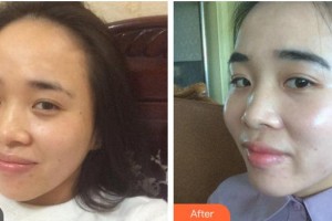 綿陽(yáng)茗匯醫(yī)療美容醫(yī)院吳承勇整形價(jià)格表附光子嫩膚案例展示