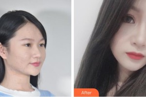 綿陽(yáng)茗匯醫(yī)療美容醫(yī)院裴亮整形價(jià)格表附眼部綜合案例展示