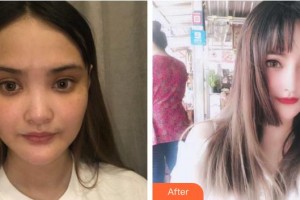 綿陽(yáng)東美奧拉克醫(yī)療美容門診部盧元?jiǎng)傉蝺r(jià)格表附耳軟骨復(fù)合隆鼻案例展示