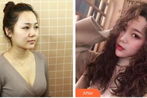 綿陽市人民醫(yī)院燒傷整形美容外科魏子人整形價(jià)格表附鼻部綜合案例展示