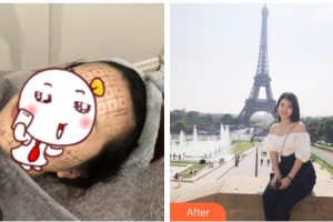 綿陽妙典整形醫(yī)院吳瑛整形價(jià)格表附熱瑪吉案例展示