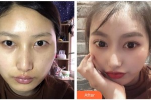 綿陽愛爾眼科醫(yī)院胥云整形價(jià)格表附切開雙眼皮案例展示