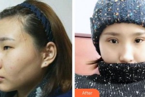 綿陽愛爾眼科醫(yī)院石玉萍整形價(jià)格表附切開雙眼皮案例展示