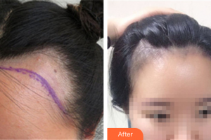 深圳華悅醫(yī)療美容門診部林宜蓉整形價格表附種植發(fā)際線案例展示