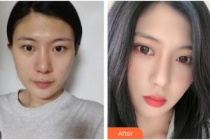 廣元美華醫(yī)學(xué)美容診所王見平整形價(jià)格表附眼部綜合案例展示