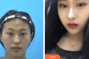 深圳潤澤瑞尼絲醫(yī)療美容醫(yī)院胡珍珍整形價格表附切開雙眼皮案例展示