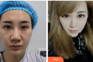 廣元市利州區(qū)第二人民醫(yī)院眼科樊樹軍整形價(jià)格表附眼部綜合案例展示