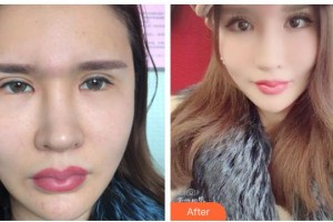 廣元市利州區(qū)中醫(yī)醫(yī)院眼科李宣整形價(jià)格表附眼部修復(fù)案例展示