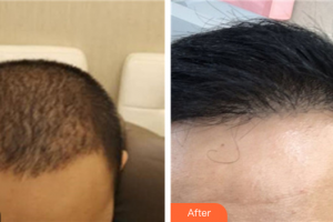 深圳黛顏醫(yī)療美容醫(yī)院李泳陀整形價格表附種植發(fā)際線案例展示