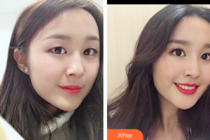 深圳美加美醫(yī)療美容門診部周國偉整形價格表附隆鼻案例展示