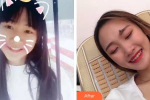 深圳美加美醫(yī)療美容門診部肖文榮整形價格表附金屬托槽牙齒矯正案例展示