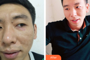 深圳美加美醫(yī)療美容門診部李莉整形價格表附激光祛斑案例展示