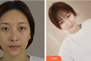 深圳建安醫(yī)療美容門診部李梓歡整形價格表附清潔祛痘案例展示