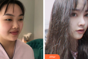 深圳建安醫(yī)療美容門診部李天石整形價格表附眼部手術+鼻部綜合案例展示