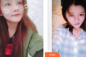 深圳建安醫(yī)療美容門診部彭一純整形價格表附牙齒隱形矯正案例展示