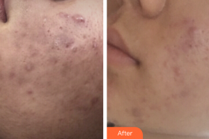 深圳建安醫(yī)療美容門診部陳史宏整形價格表附微針祛痘案例展示