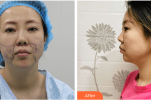 深圳悅她醫(yī)療美容診所張赫整形價格表附埋線提升案例展示