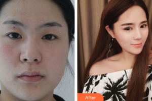 深圳德視佳眼科門診部周麗娜整形價格表附眼部手術案例展示