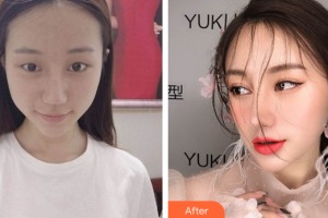 深圳陽光整形美容醫(yī)院王勇整形價格表附眼部綜合案例展示