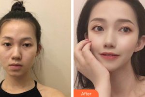 深圳陽光整形美容醫(yī)院湯躍明整形價格表附假體隆鼻案例展示