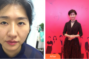 深圳陽光整形美容醫(yī)院袁野整形價格表附雙眼皮修復案例展示