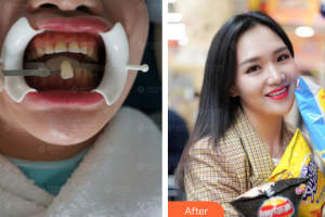 深圳松鼠悅上口腔門診部于麗軍整形價格表附牙齒美白案例展示