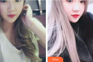 深圳松鼠悅上口腔門診部李巖整形價格表附時代天使矯正案例展示