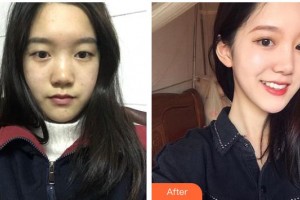 廣元市中心醫(yī)院眼科沈勇整形價(jià)格表附眼部綜合案例展示