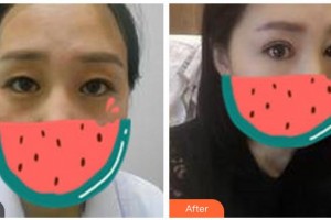 廣元萬江眼科醫(yī)院董萬江整形價格表附切開雙眼皮案例展示