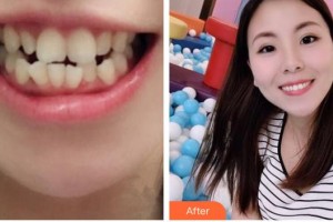 廣元口腔醫(yī)院王瑋整形價格表附金屬托槽矯正案例展示