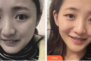 廣元口腔醫(yī)院王朝宇整形價格表附金屬托槽矯正案例展示