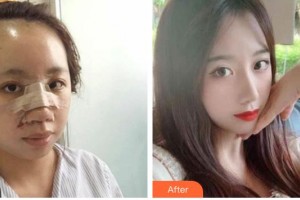 遂寧市康博醫(yī)學美容診所常太平整形價格表附鼻部綜合案例展示