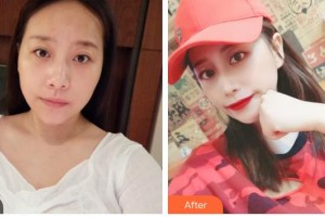 遂寧市康博醫(yī)學美容診所李紅梅整形價格表附肋軟骨隆鼻案例展示