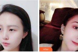 遂寧市中心醫(yī)院燒傷整形科侯勇整形價格表附鼻部綜合案例展示