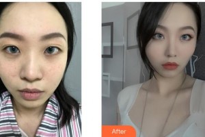 遂寧市中心醫(yī)院燒傷整形科劉唯住院醫(yī)師整形價格表附鼻翼縮小案例展示