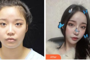 遂寧市中心醫(yī)院燒傷整形科高錦越整形價格表附肋軟骨隆鼻案例展示