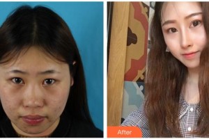 遂寧市中心醫(yī)院燒傷整形科李盛華整形價格表附肋軟骨隆鼻案例展示