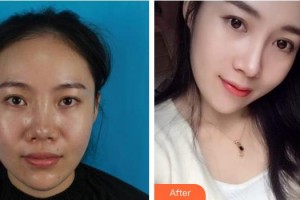 遂寧市中心醫(yī)院燒傷整形科徐敏住院醫(yī)師整形價格表附肋軟骨隆鼻案例展示