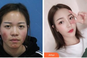 遂寧雙華醫(yī)學整形美容門診部常雙華整形價格表附膨體隆鼻案例展示