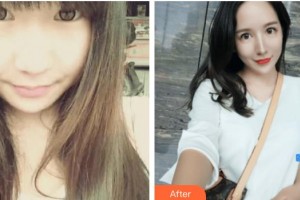 遂寧市中心醫(yī)院燒傷整形科白冰整形價格表附鼻部綜合案例展示