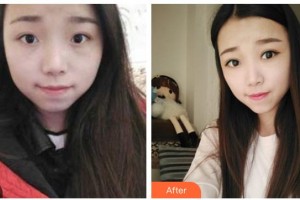 遂寧愛瑞陽光眼科醫(yī)院陳銀洪整形價格表附切開雙眼皮案例展示