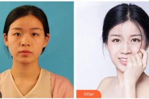 遂寧愛瑞陽光眼科醫(yī)院楊云整形價格表附眼部綜合案例展示