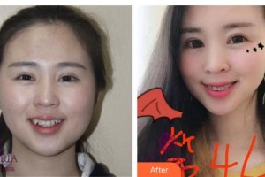 遂寧嘉慧口腔門診部呂海燕整形價格表附金屬托槽矯正案例展示