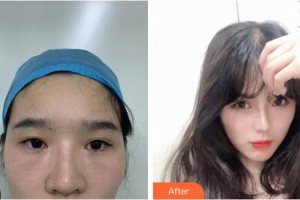 內(nèi)江百齡京菊醫(yī)療美容門(mén)診部龍卓宏整形價(jià)格表附眼部修復(fù)案例展示