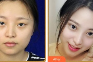 內(nèi)江百齡京菊醫(yī)療美容門(mén)診部徐勇整形價(jià)格表附眼部綜合案例展示