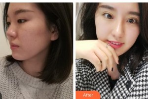 內(nèi)江百齡京菊醫(yī)療美容門(mén)診部劉培整形價(jià)格表附眼部綜合案例展示