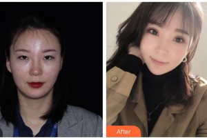 內(nèi)江百齡京菊醫(yī)療美容門(mén)診部李果整形價(jià)格表附眼部綜合案例展示