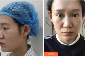 內(nèi)江瑞美醫(yī)療美容門(mén)診部楊娟整形價(jià)格表附眼部綜合案例展示